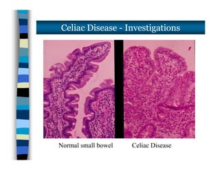 Celiac Disease - Investigations
Normal small bowel Celiac Disease
 