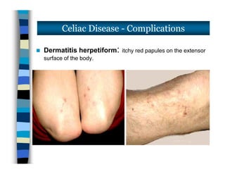  Dermatitis herpetiform: itchy red papules on the extensor
surface of the body.
Celiac Disease - Complications
 