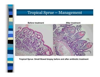 Tropical Sprue – Management
Before treatment After treatment
Tropical Sprue: Small Bowel biopsy before and after antibiotic treatment
 