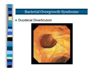  Duodenal Diverticulum
Bacterial Overgrowth Syndrome
 Duodenal Diverticulum
 