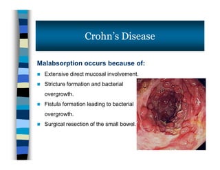 Malabsorption occurs because of:
 Extensive direct mucosal involvement.
 Stricture formation and bacterial
overgrowth.
 Fistula formation leading to bacterial
overgrowth.
 Surgical resection of the small bowel.
Crohn’s Disease
Malabsorption occurs because of:
 Extensive direct mucosal involvement.
 Stricture formation and bacterial
overgrowth.
 Fistula formation leading to bacterial
overgrowth.
 Surgical resection of the small bowel.
 