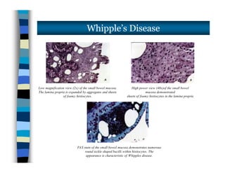 Whipple’s Disease
Low magnification view (2x) of the small bowel mucosa.
The lamina propria is expanded by aggregates and sheets
of foamy histiocytes.
High power view (40x)of the small bowel
mucosa demonstrated
sheets of foamy histiocytes in the lamina propria
Low magnification view (2x) of the small bowel mucosa.
The lamina propria is expanded by aggregates and sheets
of foamy histiocytes.
High power view (40x)of the small bowel
mucosa demonstrated
sheets of foamy histiocytes in the lamina propria
PAS stain of the small bowel mucosa demonstrates numerous
round sickle shaped bacilli within histiocytes. The
appearance is characteristic of Whipples disease.
 