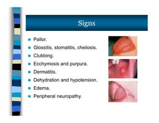 Signs
 Pallor.
 Glossitis, stomatitis, cheilosis.
 Clubbing.
 Ecchymosis and purpura.
 Dermatitis.
 Dehydration and hypotension.
 Edema.
 Peripheral neuropathy.
 Pallor.
 Glossitis, stomatitis, cheilosis.
 Clubbing.
 Ecchymosis and purpura.
 Dermatitis.
 Dehydration and hypotension.
 Edema.
 Peripheral neuropathy.
 