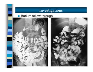  Barium follow through
Investigations
 