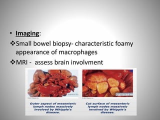 • Imaging:
Small bowel biopsy- characteristic foamy
appearance of macrophages
MRI - assess brain involvment
 