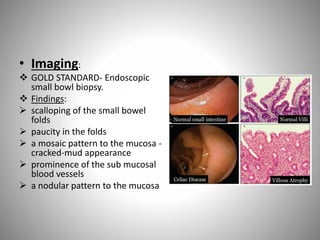 • Imaging:
 GOLD STANDARD- Endoscopic
small bowl biopsy.
 Findings:
 scalloping of the small bowel
folds
 paucity in the folds
 a mosaic pattern to the mucosa -
cracked-mud appearance
 prominence of the sub mucosal
blood vessels
 a nodular pattern to the mucosa
 