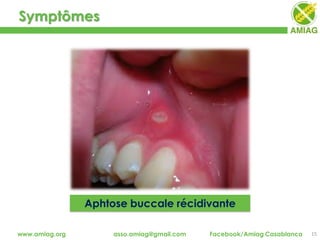 Symptômes
15www.amiag.org asso.amiag@gmail.com Facebook/Amiag Casablanca
Aphtose buccale récidivante
 