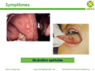 Symptômes
16www.amiag.org asso.amiag@gmail.com Facebook/Amiag Casablanca
Ulcération aphtoïde
 