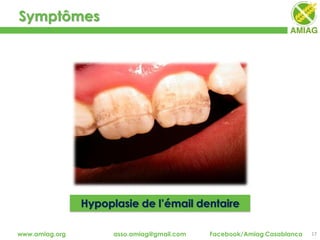 Symptômes
17www.amiag.org asso.amiag@gmail.com Facebook/Amiag Casablanca
Hypoplasie de l’émail dentaire
 