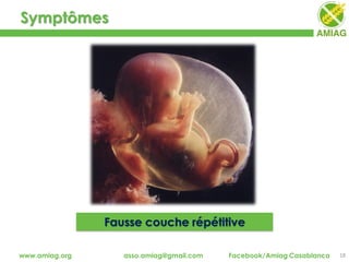 Symptômes
18www.amiag.org asso.amiag@gmail.com Facebook/Amiag Casablanca
Fausse couche répétitive
 