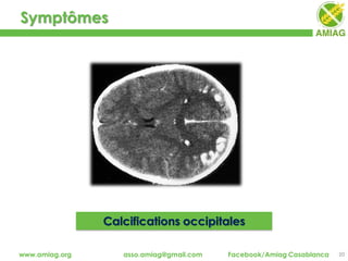 Symptômes
20www.amiag.org asso.amiag@gmail.com Facebook/Amiag Casablanca
Calcifications occipitales
 