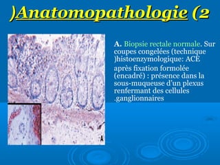 (Anatomopathologie (2
A. Biopsie rectale normale. Sur
coupes congelées (technique
(histoenzymologique: ACE
après fixation formolée
(encadré) : présence dans la
sous-muqueuse d’un plexus
renfermant des cellules
.ganglionnaires

 