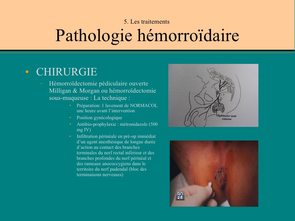 Maladie HéMorroïDaire Dm 21 04 09