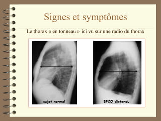 Signes et symptômes Le thorax « en tonneau » ici vu sur une radio du thorax 