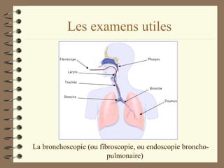 Les examens utiles La bronchoscopie (ou fibroscopie, ou endoscopie broncho-pulmonaire) 