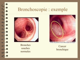 Bronchoscopie : exemple Bronches souches normales Cancer bronchique 