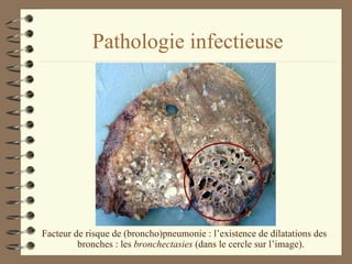 Pathologie infectieuse Facteur de risque de (broncho)pneumonie : l’existence de dilatations des bronches : les  bronchectasies  (dans le cercle sur l’image). 