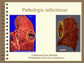 Pathologie infectieuse Collection d’une infection    formation d’un  abcès pulmonaire . 
