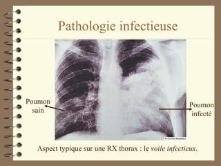 Pathologie infectieuse Aspect typique sur une RX thorax : le  voile infectieux . Poumon sain Poumon infecté 