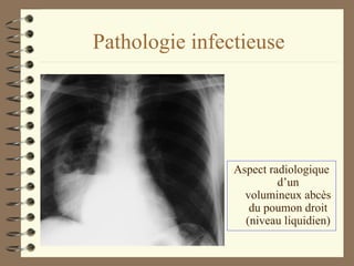 Pathologie infectieuse Aspect radiologique d’un volumineux abcès du poumon droit (niveau liquidien) 