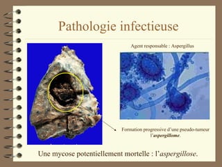 Pathologie infectieuse Une mycose potentiellement mortelle : l’ aspergillose . Agent responsable : Aspergillus Formation progressive d’une pseudo-tumeur l’ aspergillome . 