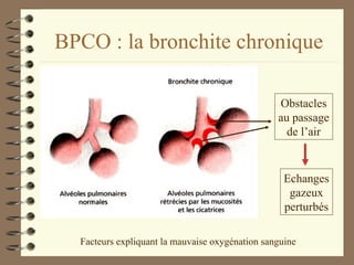 BPCO : la bronchite chronique Facteurs expliquant la mauvaise oxygénation sanguine Obstacles au passage de l’air Echanges gazeux perturbés 