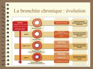 La bronchite chronique : évolution 