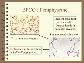 BPCO : l’emphysème Tissu pulmonaire normal Poumon emphysémateux Element constitutif de la maladie : Destruction de la paroi des alvéoles. Evolution vers la formation de  bulles  d’emphysème. 