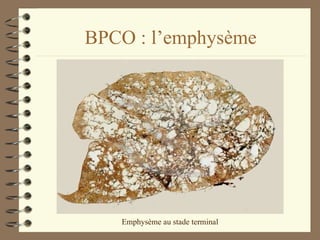 BPCO : l’emphysème Emphysème au stade terminal 