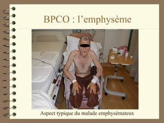 BPCO : l’emphysème Aspect typique du malade emphysémateux 