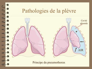 Pathologies de la plèvre Principe du pneumothorax AIR Cavité pleurale 