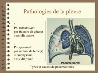 Pathologies de la plèvre Types et causes de pneumothorax : Pn.  traumatique par fracture de côte(s) aussi dit  ouvert : Pn.  spontané par rupture de bulle(s) d’emphysème aussi dit  fermé 