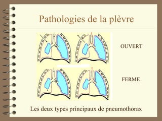 Pathologies de la plèvre Les deux types principaux de pneumothorax OUVERT FERME 