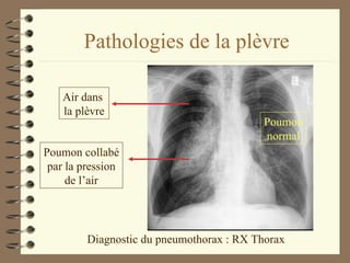 Pathologies de la plèvre Diagnostic du pneumothorax : RX Thorax Air dans  la plèvre Poumon collabé par la pression de l’air Poumon normal 