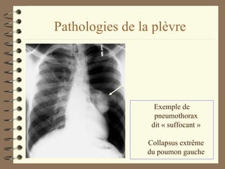 Pathologies de la plèvre Exemple de pneumothorax dit « suffocant » Collapsus extrême du poumon gauche 
