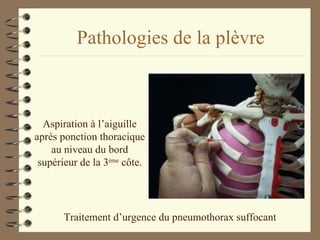 Pathologies de la plèvre Traitement d’urgence du pneumothorax suffocant Aspiration à l’aiguille après ponction thoracique au niveau du bord supérieur de la 3 ème  côte. 