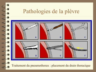 Pathologies de la plèvre Traitement du pneumothorax : placement du drain thoracique 