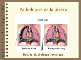 Pathologies de la plèvre Résultat du drainage thoracique 