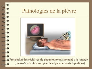 Pathologies de la plèvre Prévention des récidives de pneumothorax spontané : le  talcage pleural  (valable aussi pour les épanchements liquidiens) 