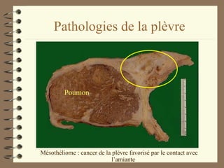 Pathologies de la plèvre Mésothéliome : cancer de la plèvre favorisé par le contact avec l’amiante Poumon 