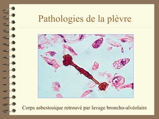 Pathologies de la plèvre Corps asbestosique retrouvé par lavage broncho-alvéolaire 