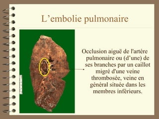 L’embolie pulmonaire Occlusion aiguë de l'artère pulmonaire ou (d’une) de ses branches par un caillot migré d'une veine thrombosée, veine en général située dans les membres inférieurs. 