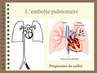 L’embolie pulmonaire Progression du caillot 