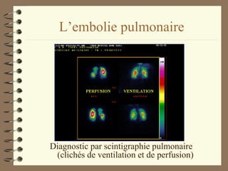 L’embolie pulmonaire Diagnostic par scintigraphie pulmonaire (clichés de ventilation et de perfusion) 