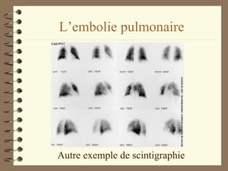 L’embolie pulmonaire Autre exemple de scintigraphie 