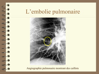 L’embolie pulmonaire Angiographie pulmonaire montrant des caillots 