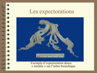Les expectorations Exemple d’expectoration dense  « moulée » sur l’arbre bronchique 