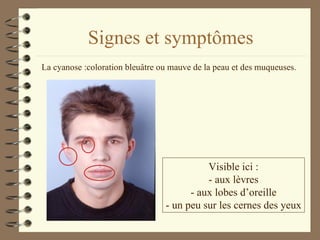 Signes et symptômes La cyanose : coloration bleuâtre ou mauve de la peau et des muqueuses.  Visible ici : - aux lèvres - aux lobes d’oreille - un peu sur les cernes des yeux 