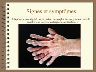 Signes et symptômes L’hippocratisme digital : déformation des ongles des doigts « en verre de montre » ou doigts « en baguettes de tambour » 