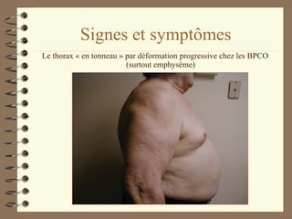 Signes et symptômes Le thorax « en tonneau » par déformation progressive chez les BPCO (surtout emphysème) 